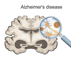 Innovation in Alzheimer’s disease needs more than pharmaceutical solutions