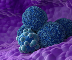 AI model detects very early normally ‘invisible’ tissue changes of pancreatic cancer