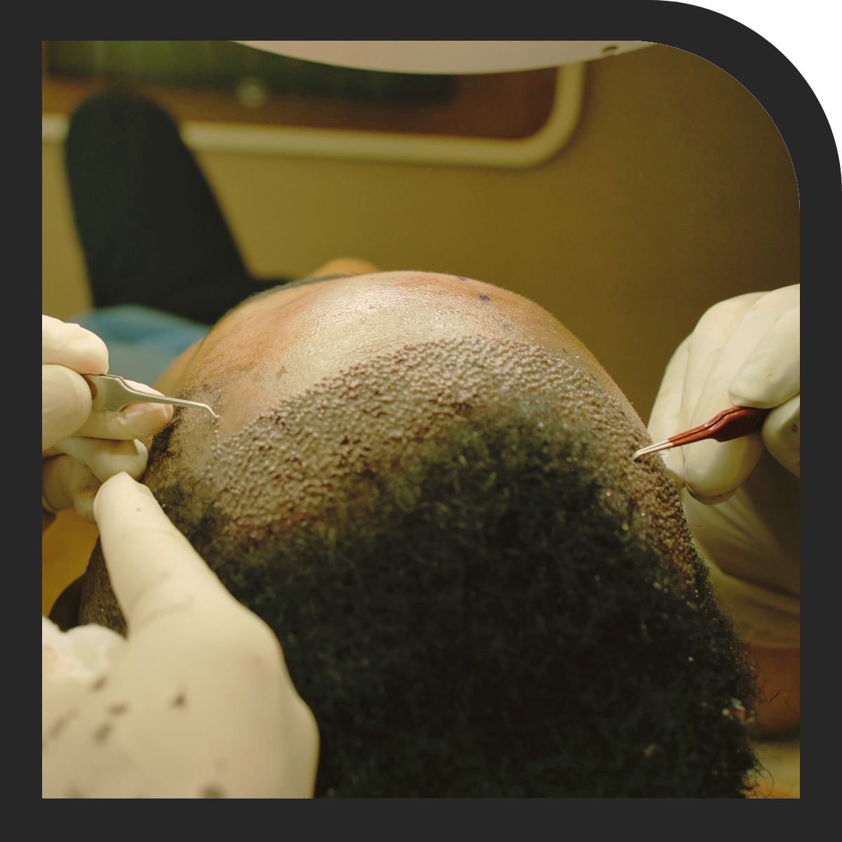 Hair loss treatments and hair transplants at AesthetiX Live London Excel 10-11 April 2027