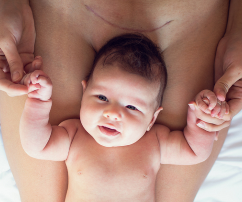 How to Have Skin-to-Skin at C-Section