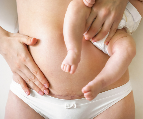 C-Section Massage: Why and How Should You Do It