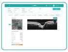 AI for OCT: Glaucoma Advanced Optic Disc Analysis