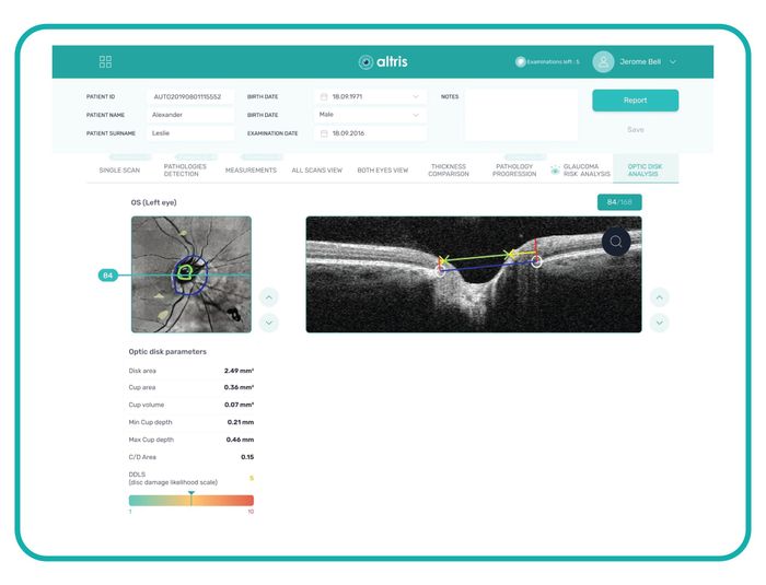 AI for OCT: Glaucoma Advanced Optic Disc Analysis