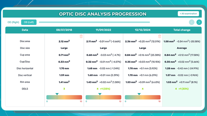 AI for OCT: Glaucoma Advanced Optic Disc Analysis