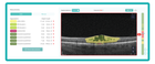 AI for OCT: Pathologies Detection