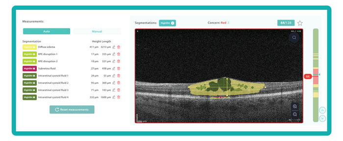 AI for OCT: Pathologies Detection