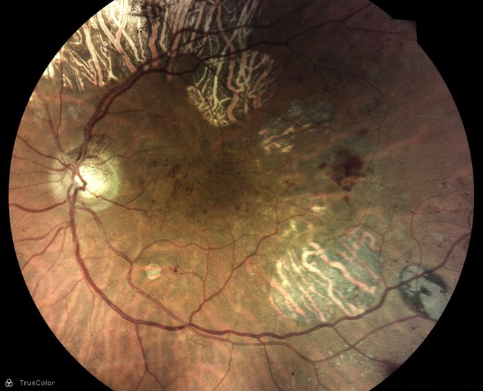 iCare DRSplus - TrueColor Confocal Fundus Imaging System