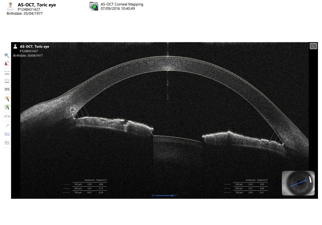CSO MS-39 Anterior Segment OCT