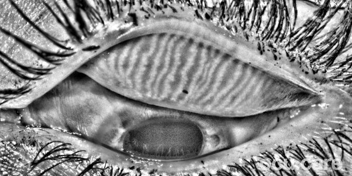 MEA – Dry Eye Examination Made Simple