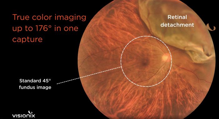 Visionix VX625 Automated UWF Fundus Camera
