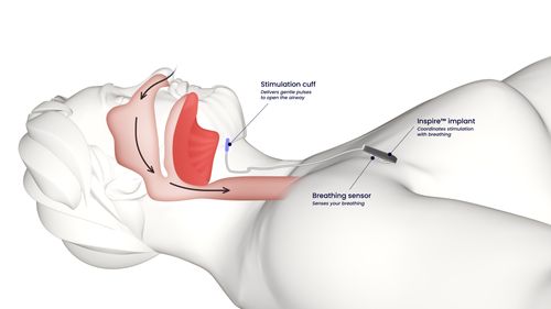 More NHS Hospitals in England Choose Inspire Therapy for OSA Patients. Hospitals in London, the Southeast, Northwest & West Midlands to set up implantation centres to treat CPAP-intolerant OSA patients.