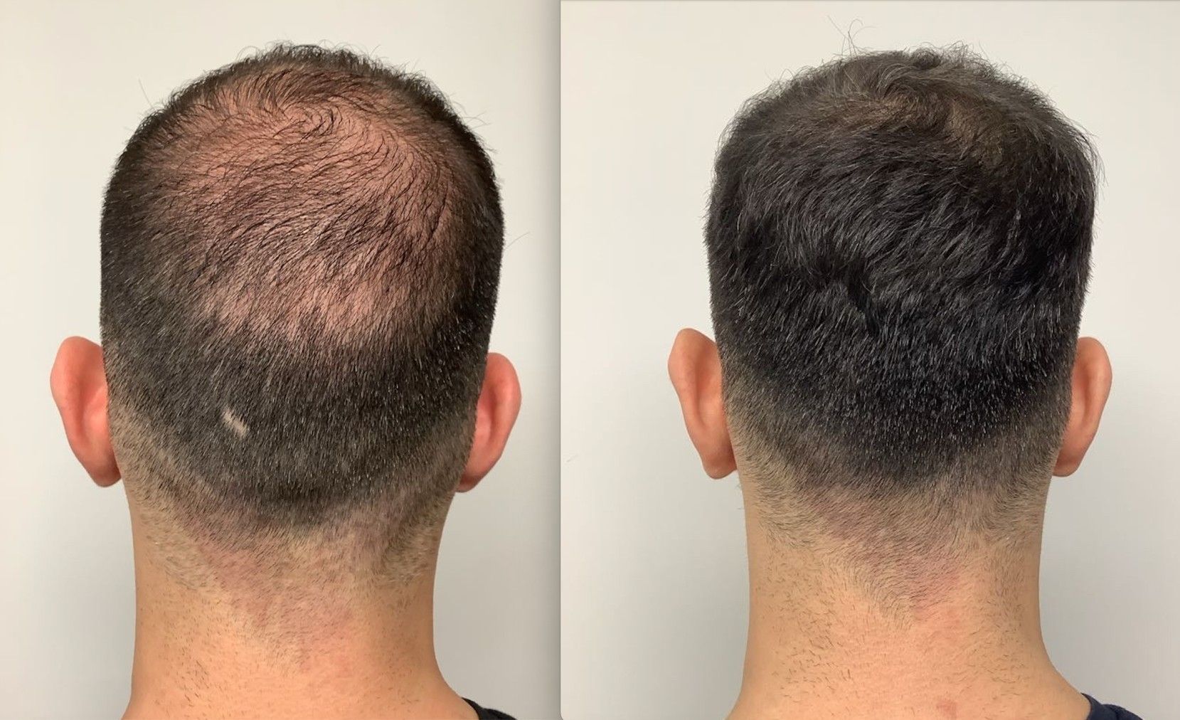 Hair Loss Profile