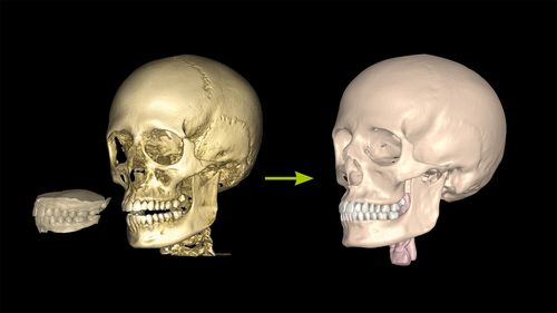 Bone Doctor software module | Zirkonzahn.Modifier 