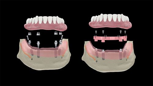 Zirkonzahn's Implant Prosthetic Components