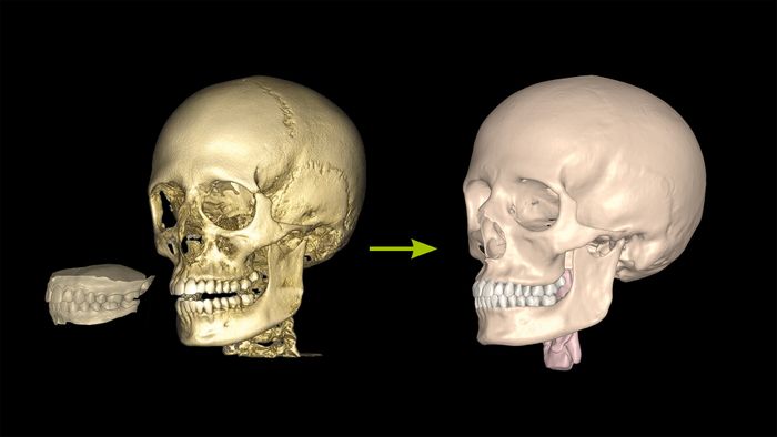 Bone Doctor - New software module for precise surgical planning