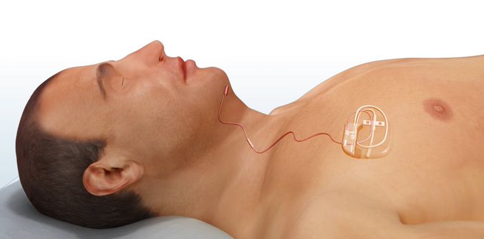 Inspire Medical Systems