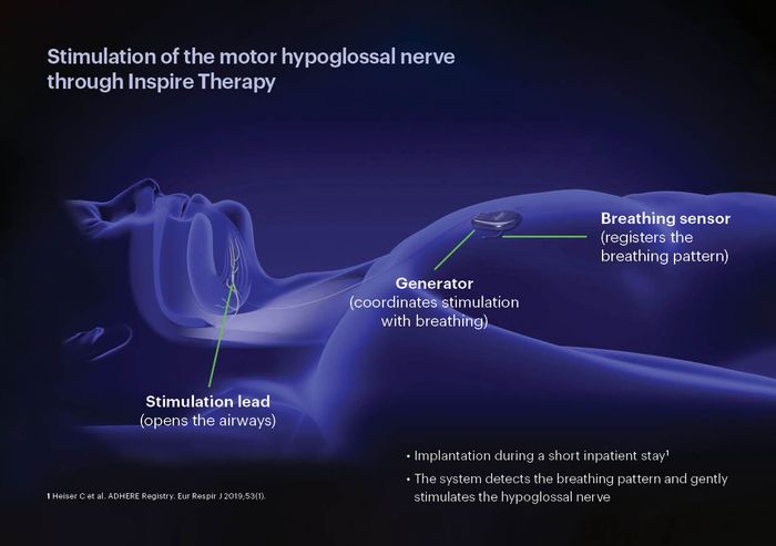 Inspire Medical Systems