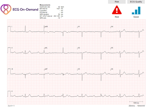 Confidently Manage Your Patients With Expert 12-Lead ECG Reports