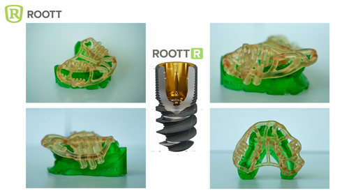 Open Dental Implant guide by ROOTT