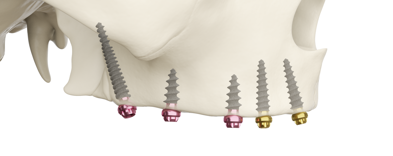 ROOTT Implants