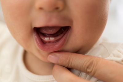 Sugar and breastfeeding could impact dental caries in infants