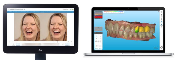 Align Technology Announces New Innovations for iTero™ Digital Solutions, a Comprehensive Ecosystem That Includes Intraoral Scanners and Integrated Software Tools That Enhance the Chairside Patient Experience
