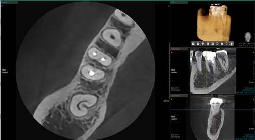 Highest resolution CBCT
