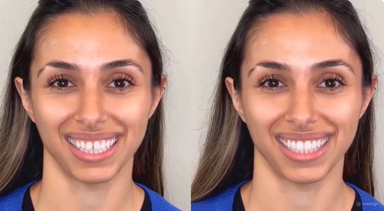 Invisalign® Smile Video