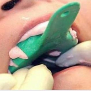 Advanced Impression Course & Shade Selection 