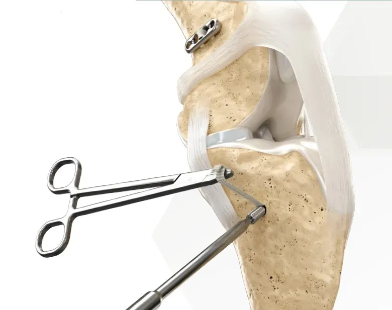 Extracapsular CrCL Repair Lab Image