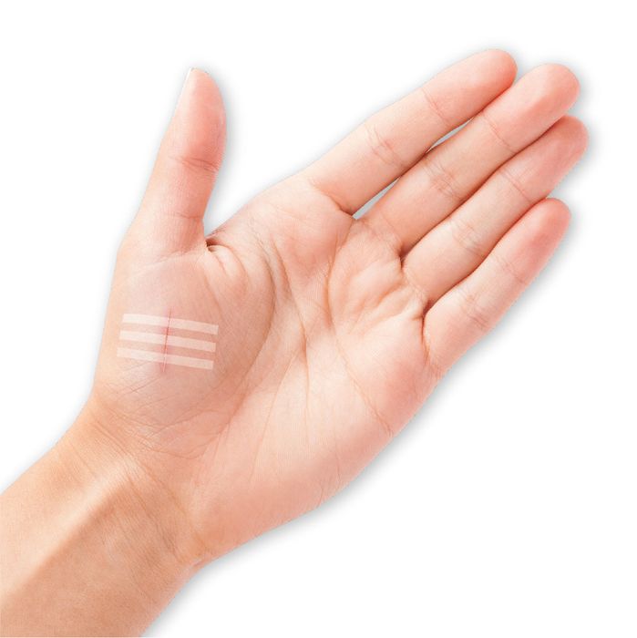 Protek Health Adhesive Wound Closures