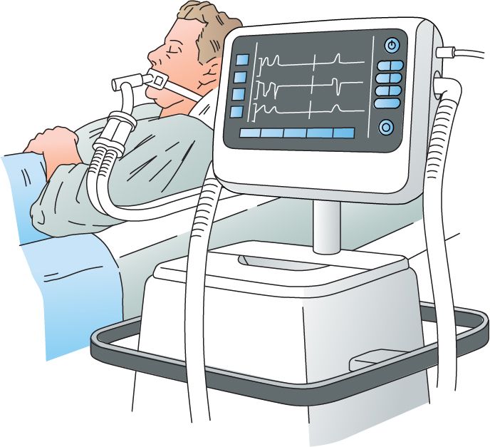 Superior Sensor Technology’s New Ventilator Pressure Sensors with Extreme Resolution Expand Dynamic Range to Support All Patients