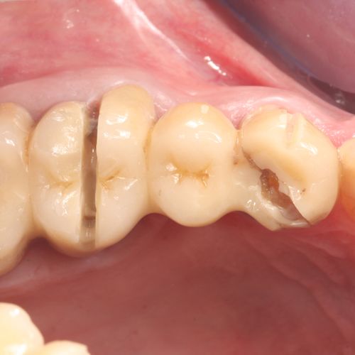 Zirconia Crown Cutters