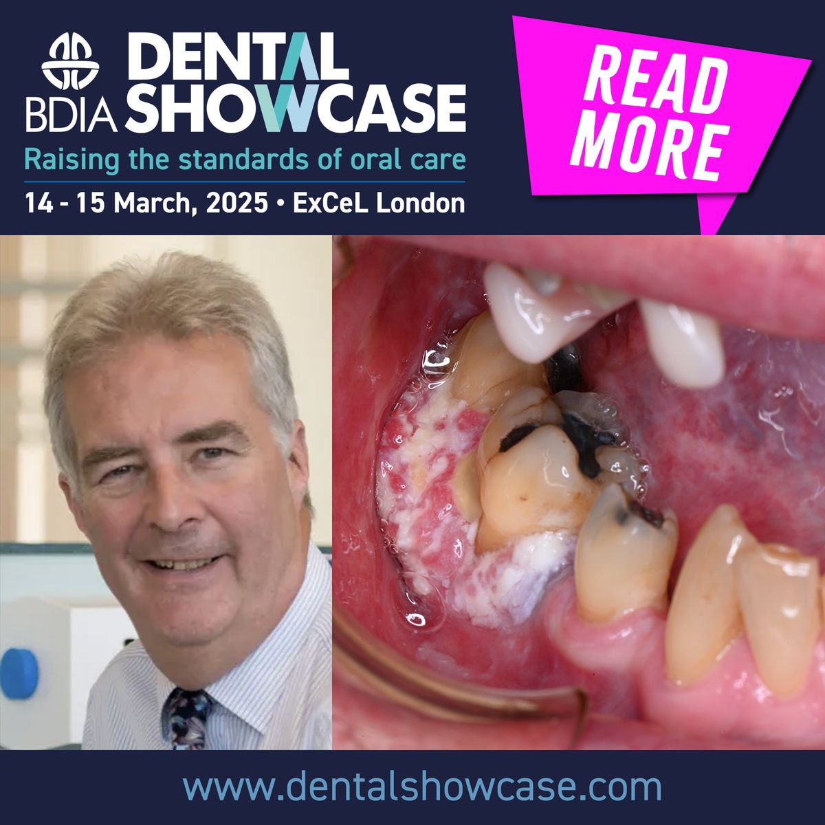 The Fight Against Mouth Cancer Continues at BDIA Dental Showcase 2025