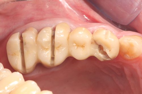 Zirconia Crown and Bridge Cutter