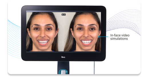 Invisalign&reg; Outcome Simulator Pro with Smile Video