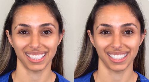 Invisalign&reg; Smile Video