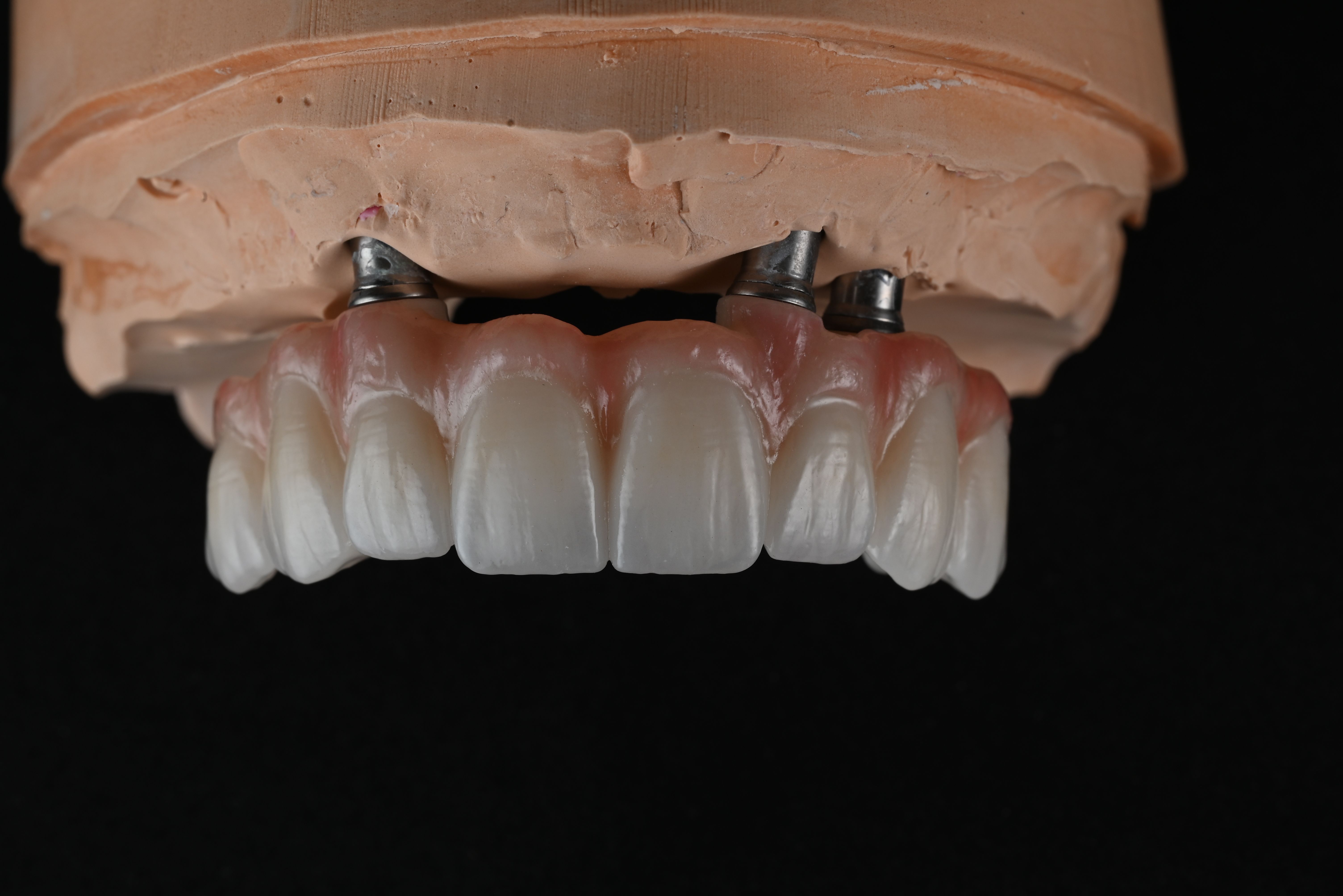 Screw retained implants