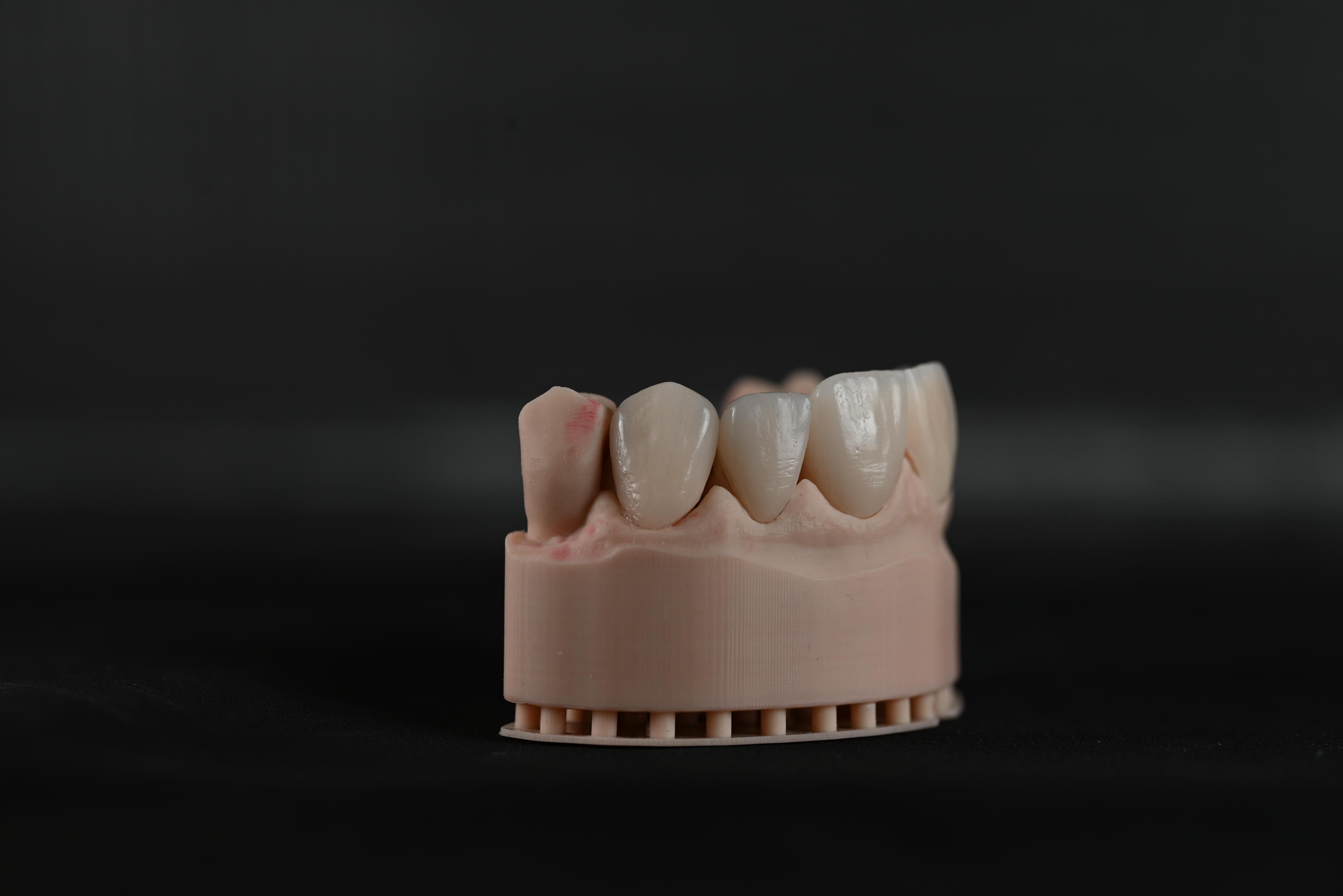Layered Zirconia crown