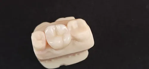 Zirconia inlay/onlay/overlay