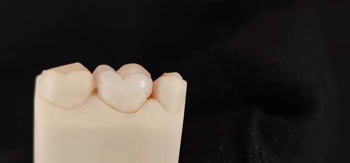Zirconia inlay/onlay/overlay