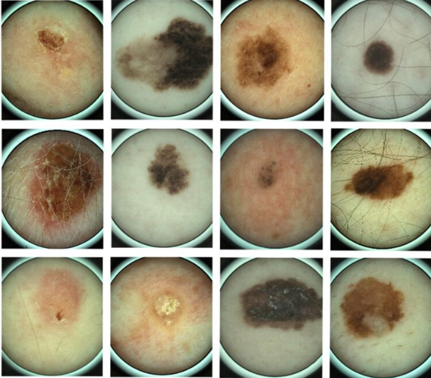 DermoSight Teledermoscopy Solution
