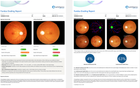 Eyetelligence AI Software and handheld Fundus Camera