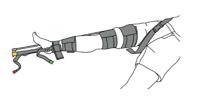 TraumaFix - Traction Splint