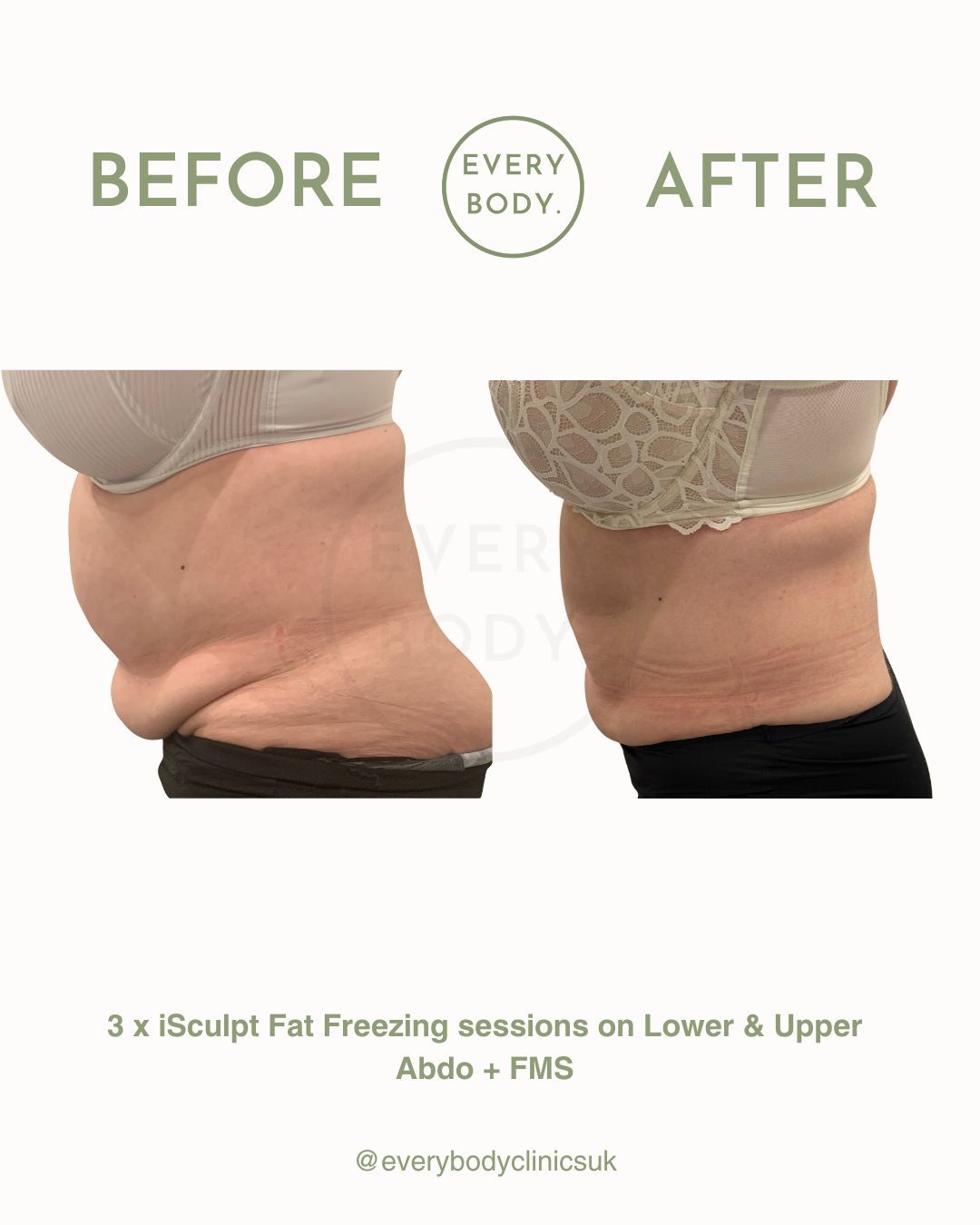 Luxury Body Sculpting by Everybody Clinics, Wimbledon